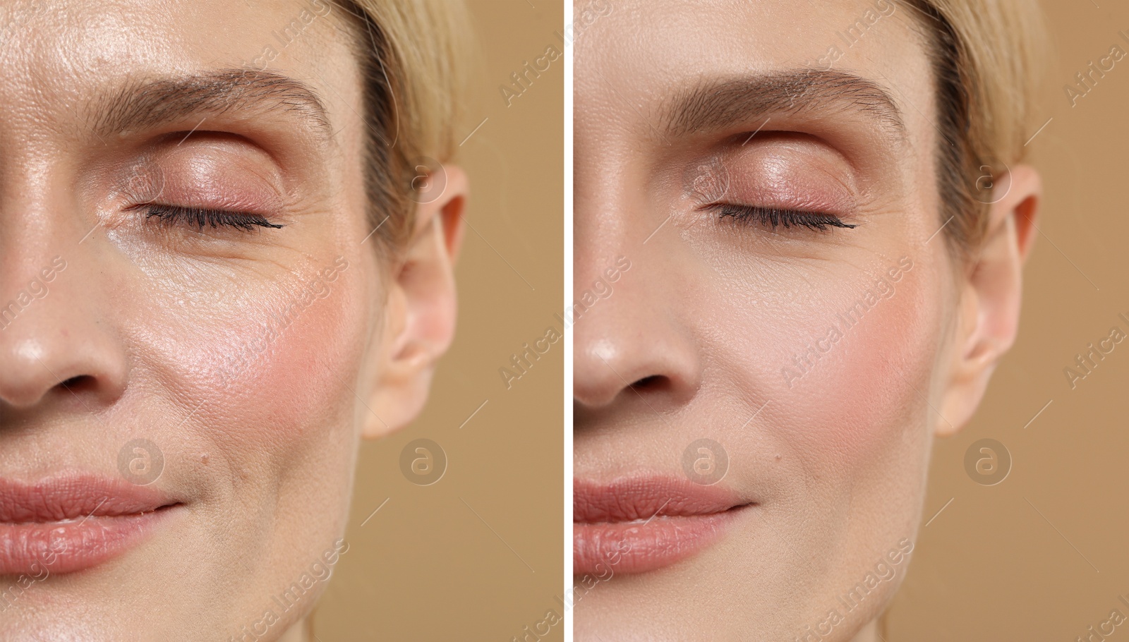 Woman showing face before and after collagen consumption on beige background, closeup. Collage of photos comparing skin condition Image of Woman showing face before and after collagen consumption on beige background, closeup. Collage of photos comparing skin condition