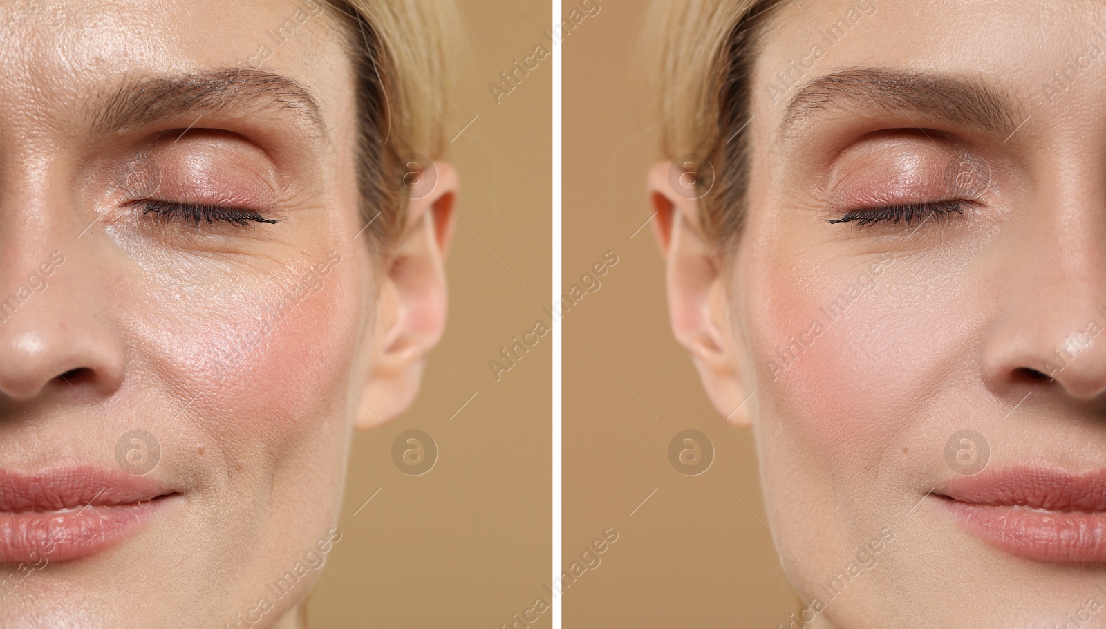 Woman showing face before and after collagen consumption on beige background, closeup. Collage of photos comparing skin condition Image of Woman showing face before and after collagen consumption on beige background, closeup. Collage of photos comparing skin condition
