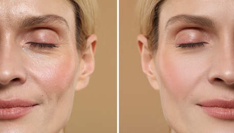 Image of Woman showing face before and after collagen consumption on beige background, closeup. Collage of photos comparing skin condition