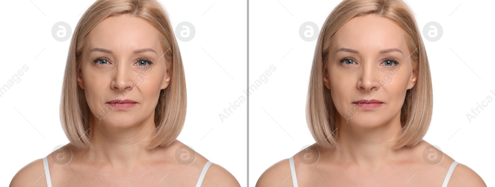 Woman showing face before and after collagen consumption on white background. Collage of photos comparing skin condition Image of Woman showing face before and after collagen consumption on white background. Collage of photos comparing skin condition