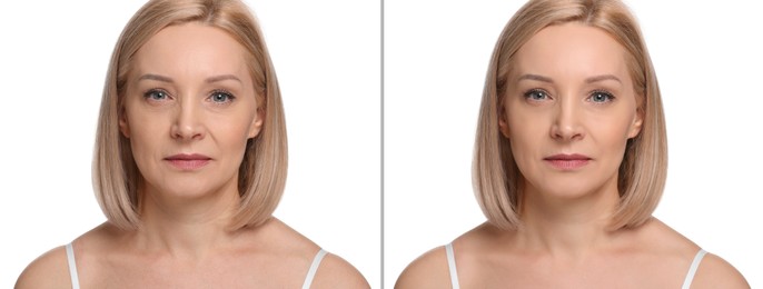 Image of Woman showing face before and after collagen consumption on white background. Collage of photos comparing skin condition