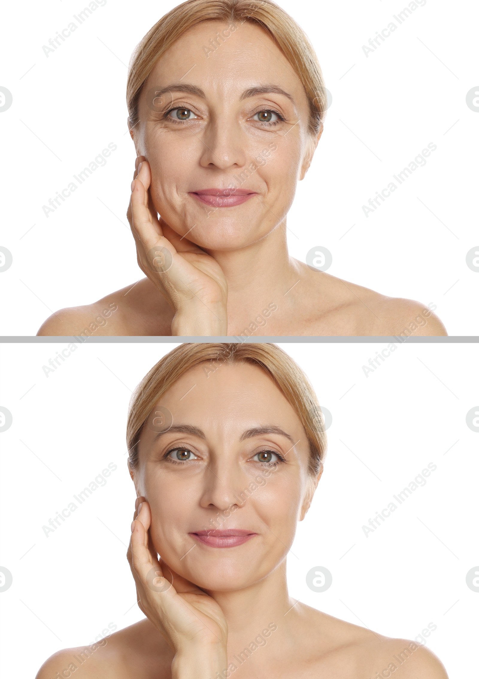 Woman showing face before and after collagen consumption on white background. Collage of photos comparing skin condition Image of Woman showing face before and after collagen consumption on white background. Collage of photos comparing skin condition