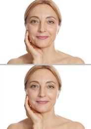 Image of Woman showing face before and after collagen consumption on white background. Collage of photos comparing skin condition