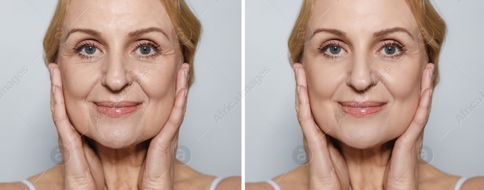 Senior woman showing face before and after collagen consumption on light grey background, closeup. Collage of photos comparing skin condition Image of Senior woman showing face before and after collagen consumption on light grey background, closeup. Collage of photos comparing skin condition