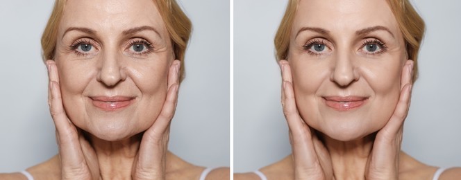 Image of Senior woman showing face before and after collagen consumption on light grey background, closeup. Collage of photos comparing skin condition