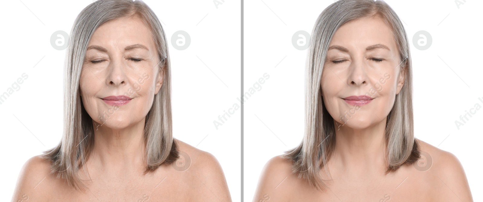 Senior woman showing face before and after collagen consumption on white background. Collage of photos comparing skin condition Image of Senior woman showing face before and after collagen consumption on white background. Collage of photos comparing skin condition