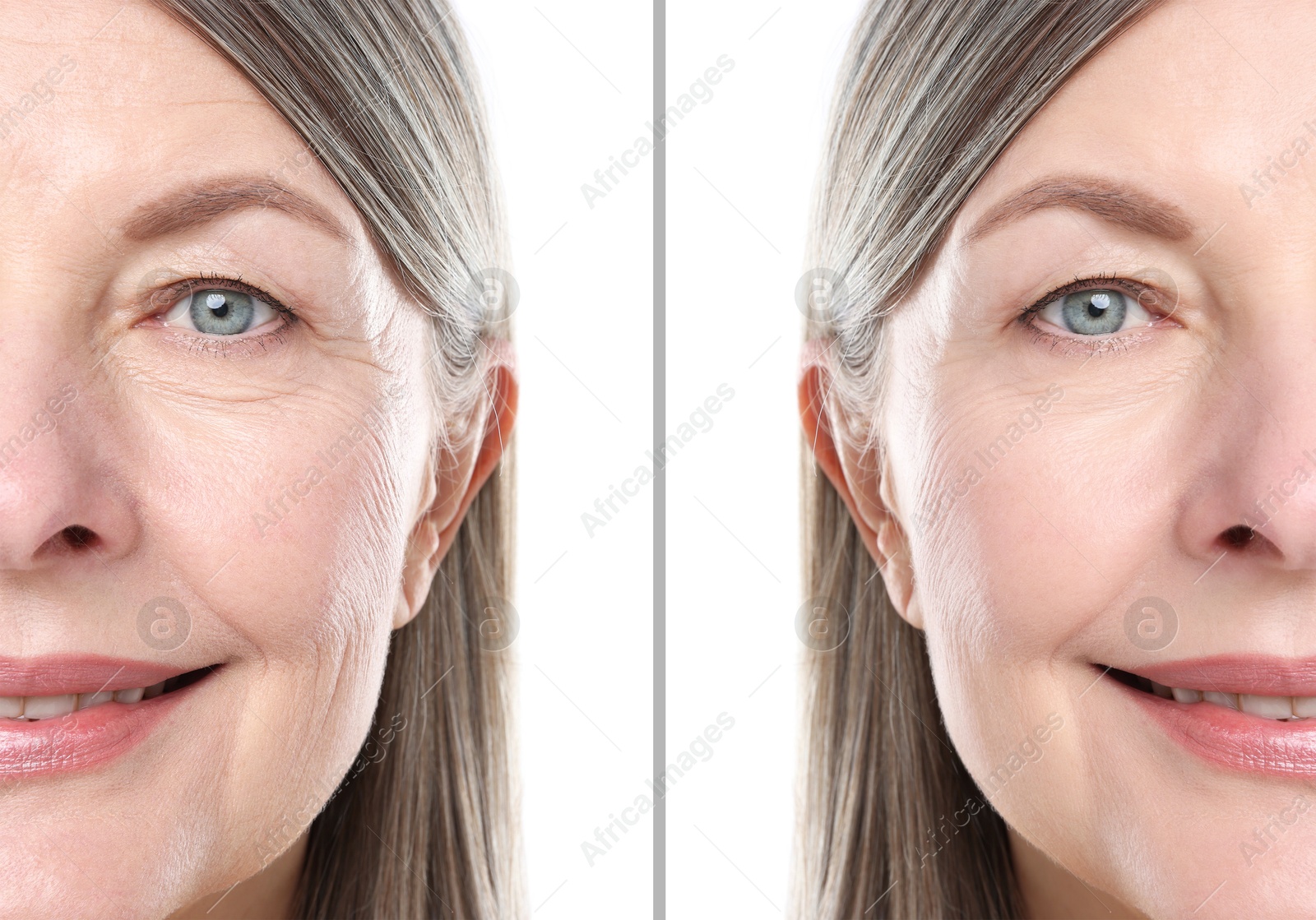 Senior woman showing face before and after collagen consumption on white background, closeup. Collage of photos comparing skin condition Image of Senior woman showing face before and after collagen consumption on white background, closeup. Collage of photos comparing skin condition