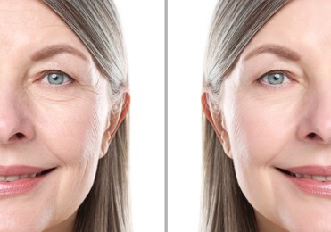 Image of Senior woman showing face before and after collagen consumption on white background, closeup. Collage of photos comparing skin condition