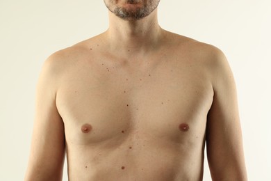 Photo of Man with moles on his skin against light background, closeup