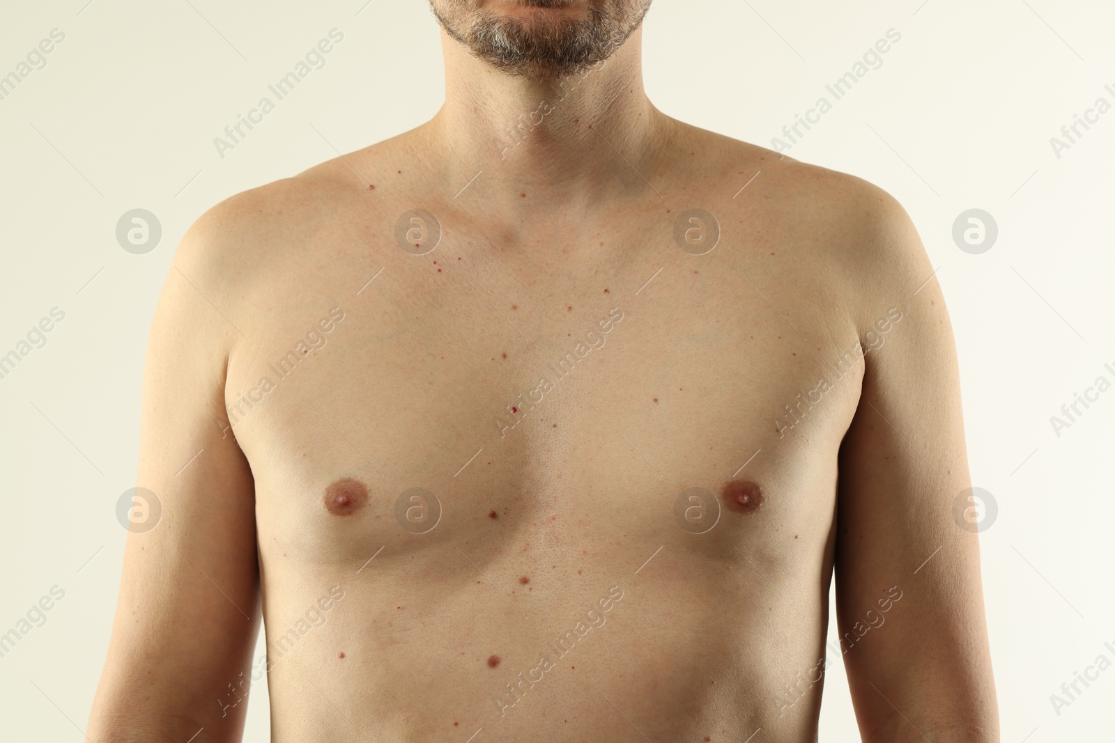 Man with moles on his skin against light background, closeup Photo of Man with moles on his skin against light background, closeup