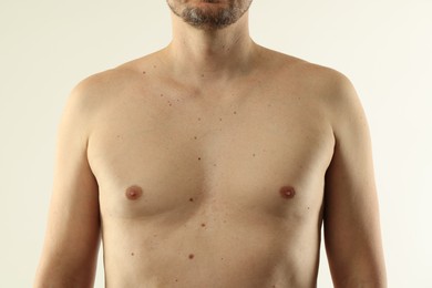 Photo of Man with moles on his skin against light background, closeup