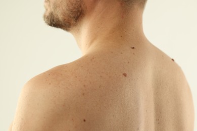 Photo of Man with moles on his skin against light background, closeup