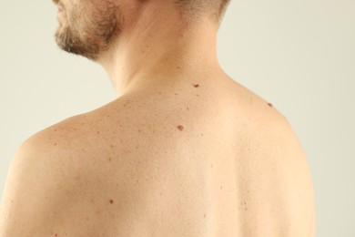 Photo of Man with moles on his skin against light background, closeup