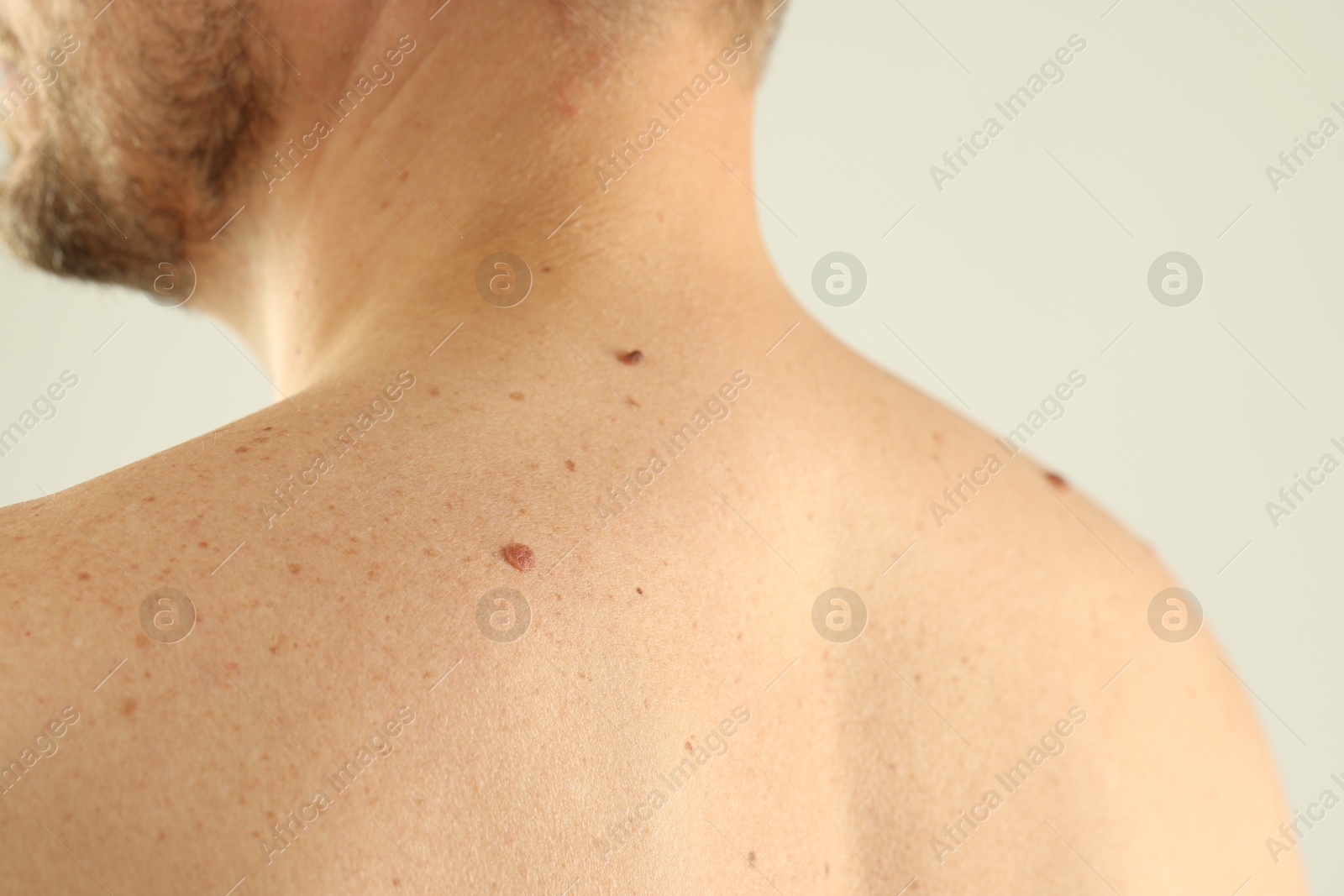 Man with moles on his skin against light background, closeup Photo of Man with moles on his skin against light background, closeup