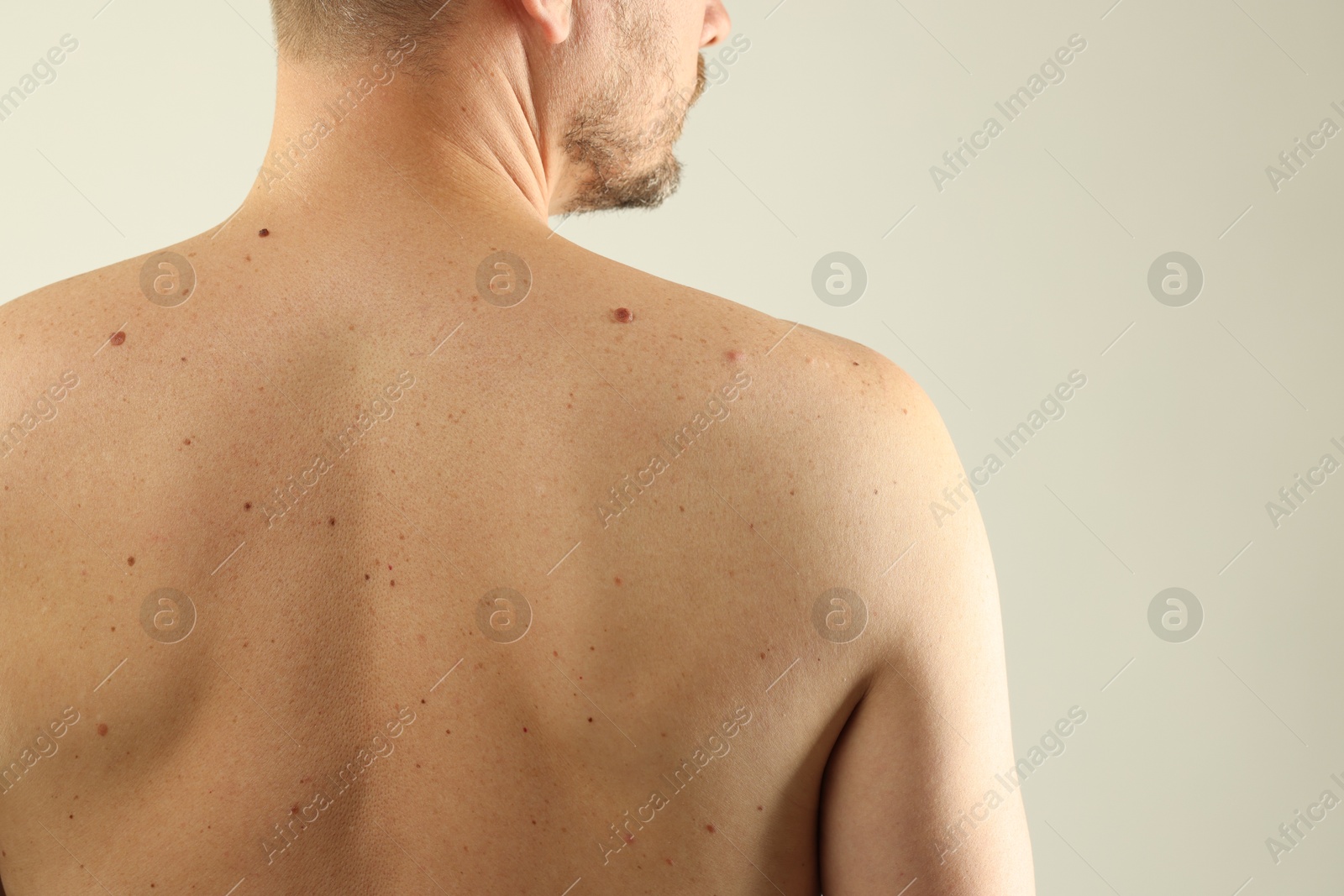 Man with moles on his skin against light background, closeup. Space for text Photo of Man with moles on his skin against light background, closeup. Space for text
