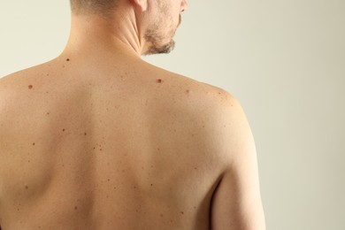 Photo of Man with moles on his skin against light background, closeup. Space for text