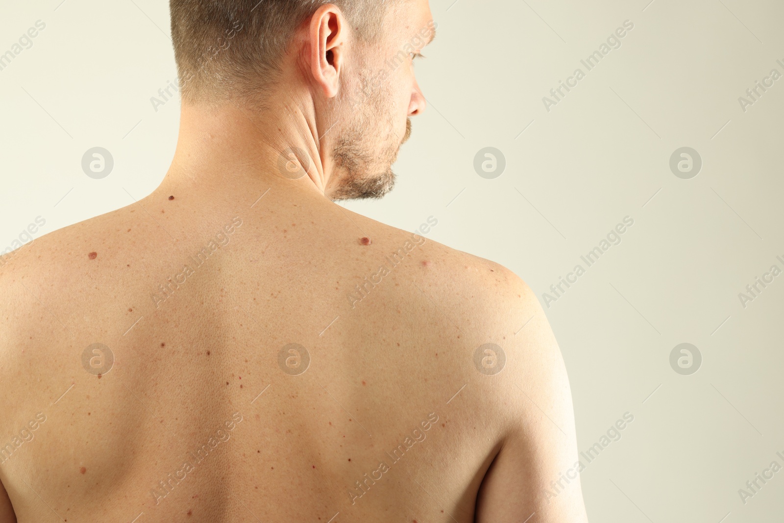 Man with moles on his skin against light background, closeup. Space for text Photo of Man with moles on his skin against light background, closeup. Space for text