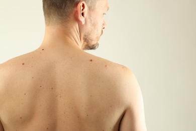 Photo of Man with moles on his skin against light background, closeup. Space for text