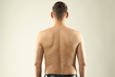 Photo of Man with moles on his skin against light background, back view