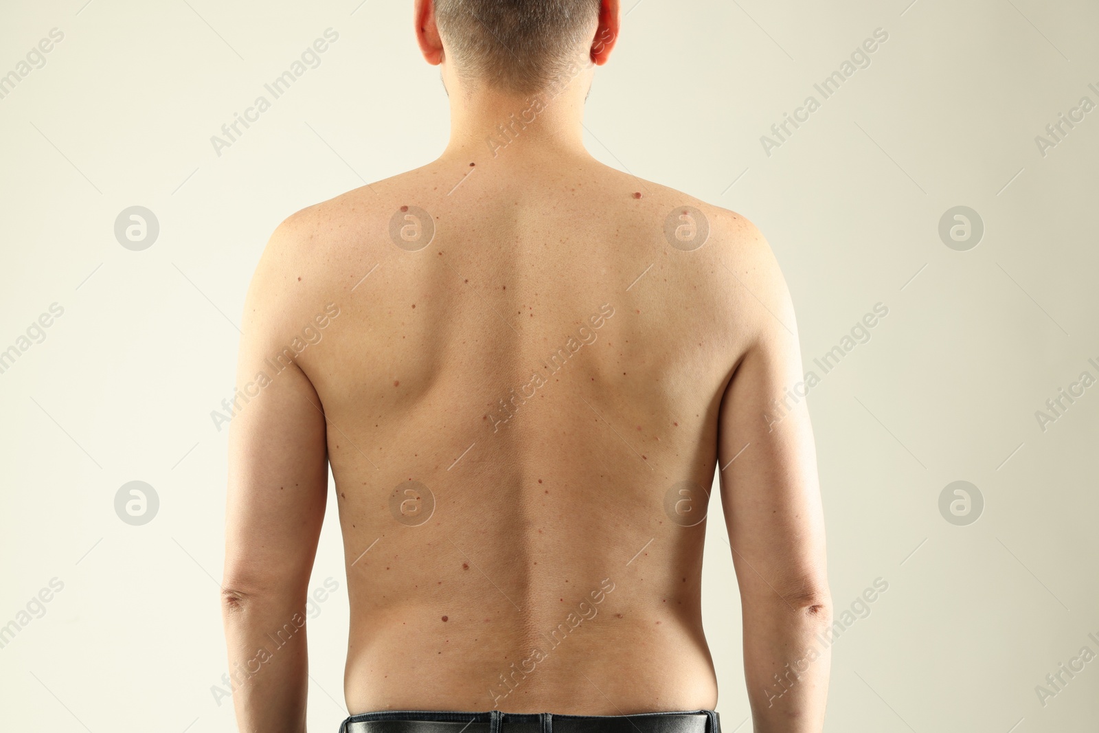 Man with moles on his skin against light background, closeup Photo of Man with moles on his skin against light background, closeup