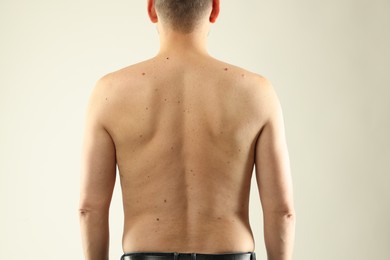 Photo of Man with moles on his skin against light background, closeup