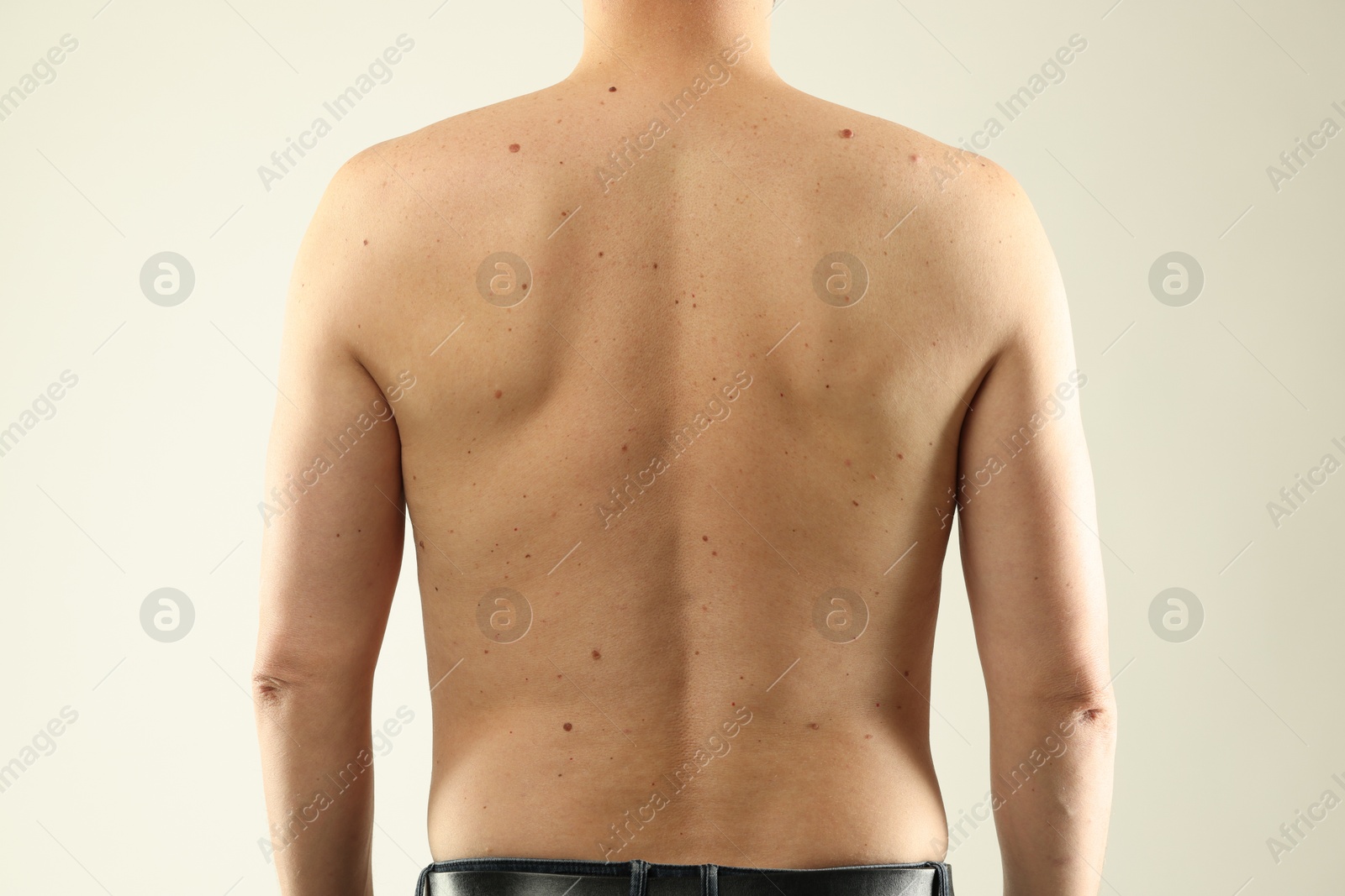 Man with moles on his skin against light background, closeup Photo of Man with moles on his skin against light background, closeup