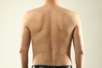 Photo of Man with moles on his skin against light background, closeup