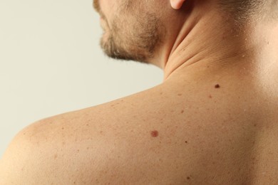 Photo of Man with moles on his skin against light background, closeup