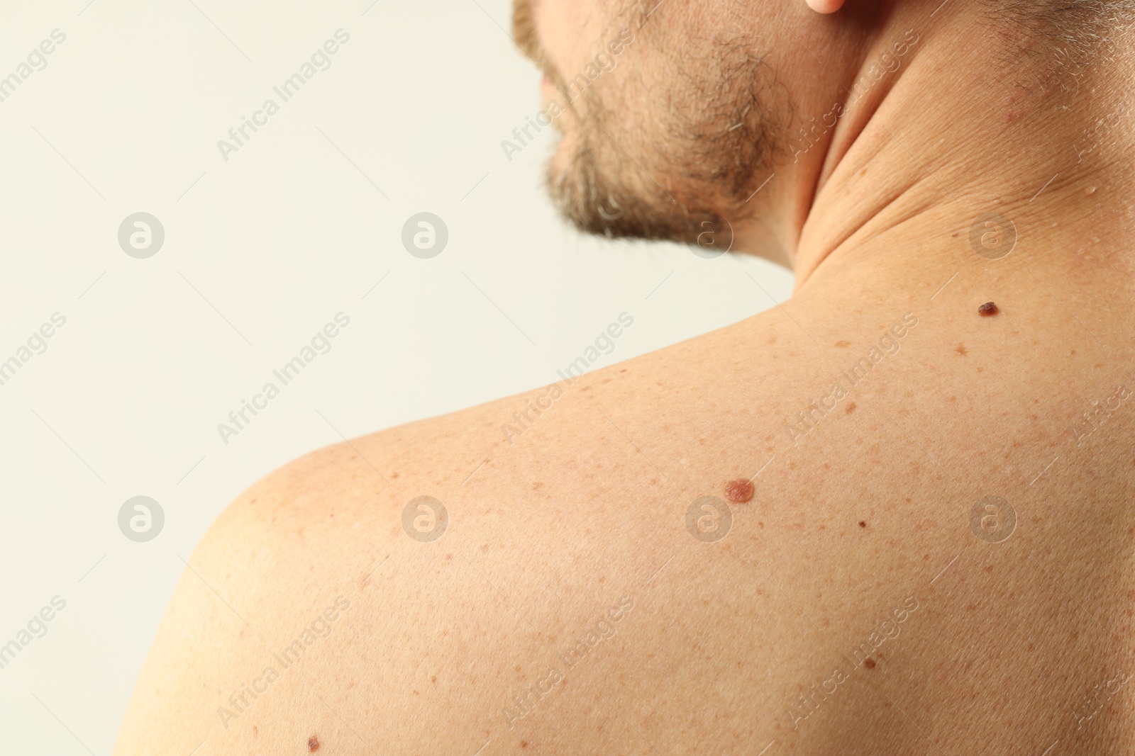 Man with moles on his skin against light background, closeup Photo of Man with moles on his skin against light background, closeup
