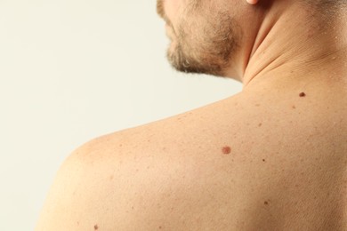 Photo of Man with moles on his skin against light background, closeup