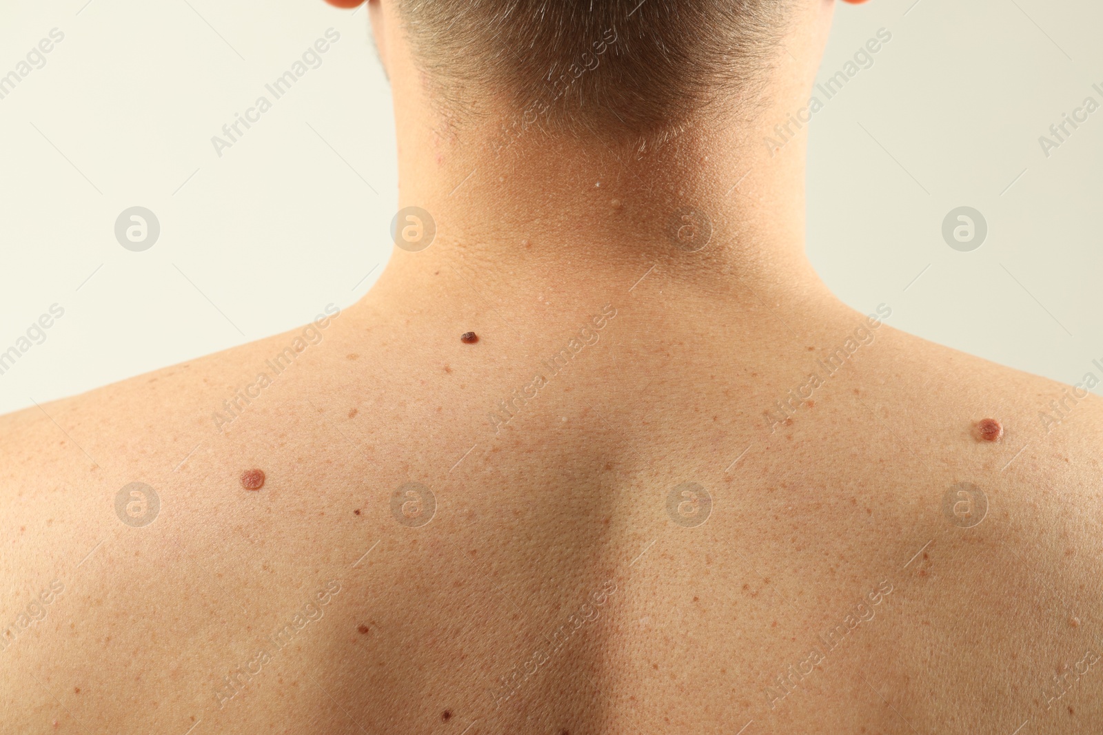 Man with moles on his skin against light background, closeup Photo of Man with moles on his skin against light background, closeup