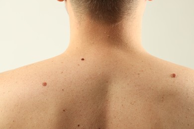Photo of Man with moles on his skin against light background, closeup