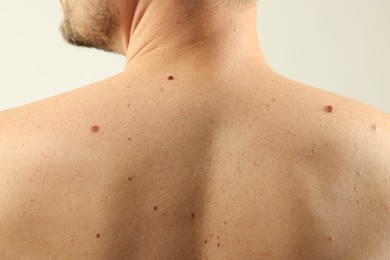Photo of Man with moles on his skin against light background, closeup