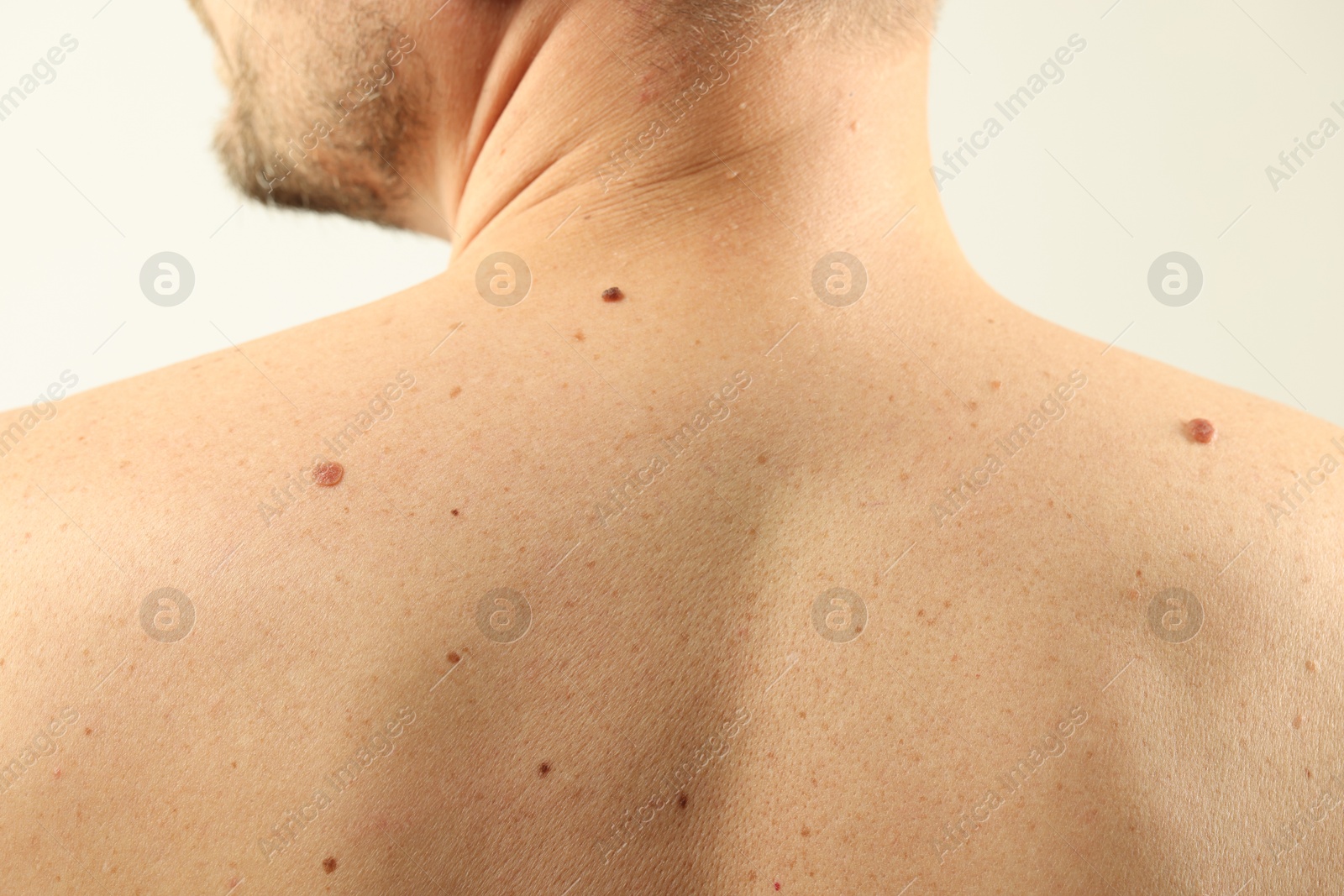 Man with moles on his skin against light background, closeup Photo of Man with moles on his skin against light background, closeup