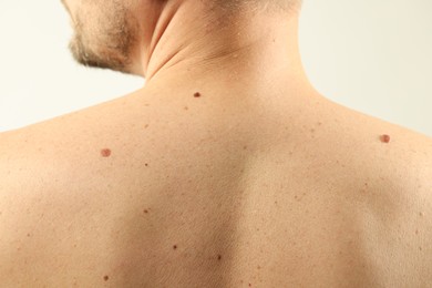 Photo of Man with moles on his skin against light background, closeup