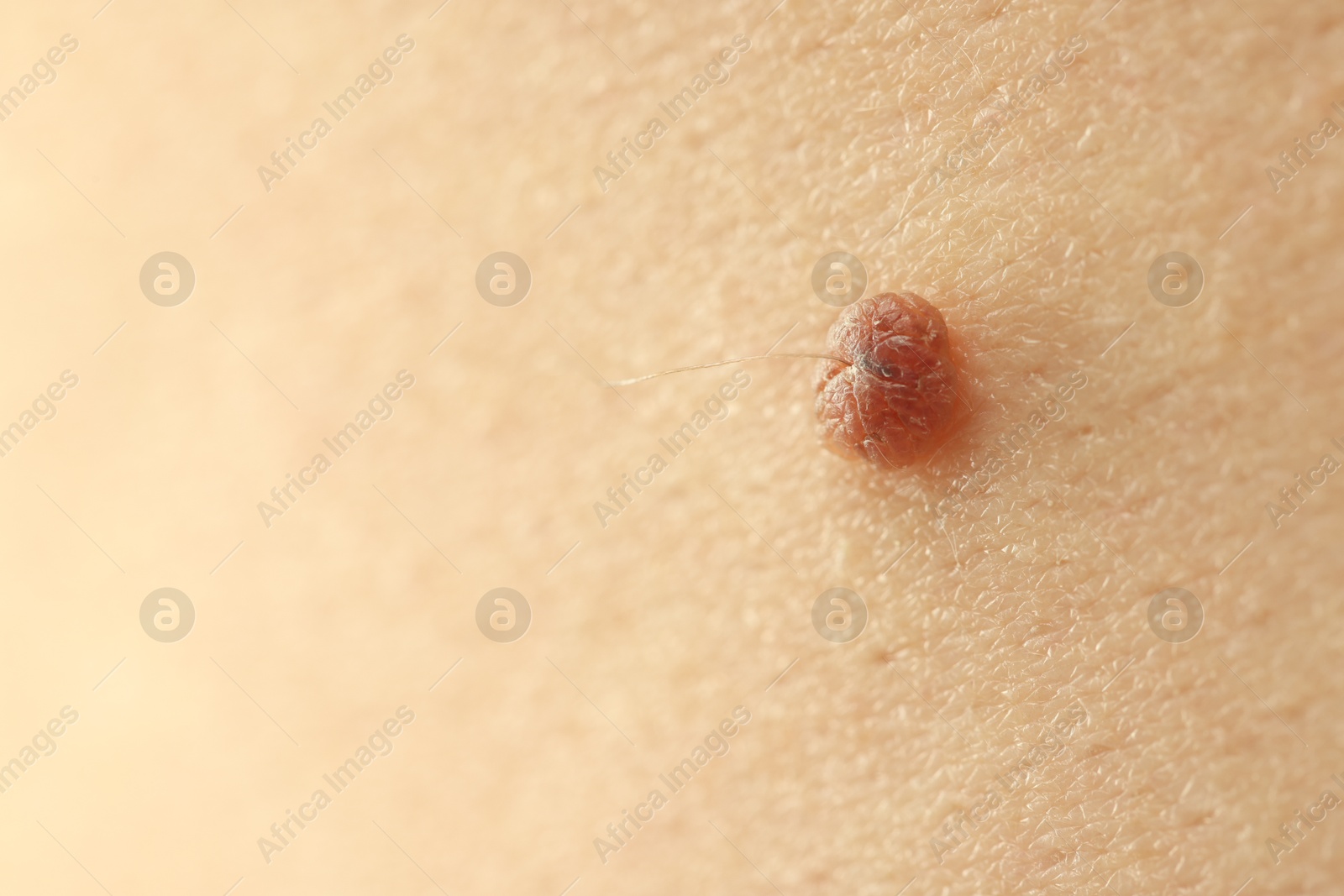 Man with mole on his skin, closeup. Space for text Photo of Man with mole on his skin, closeup. Space for text