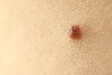 Photo of Man with mole on his skin, closeup. Space for text