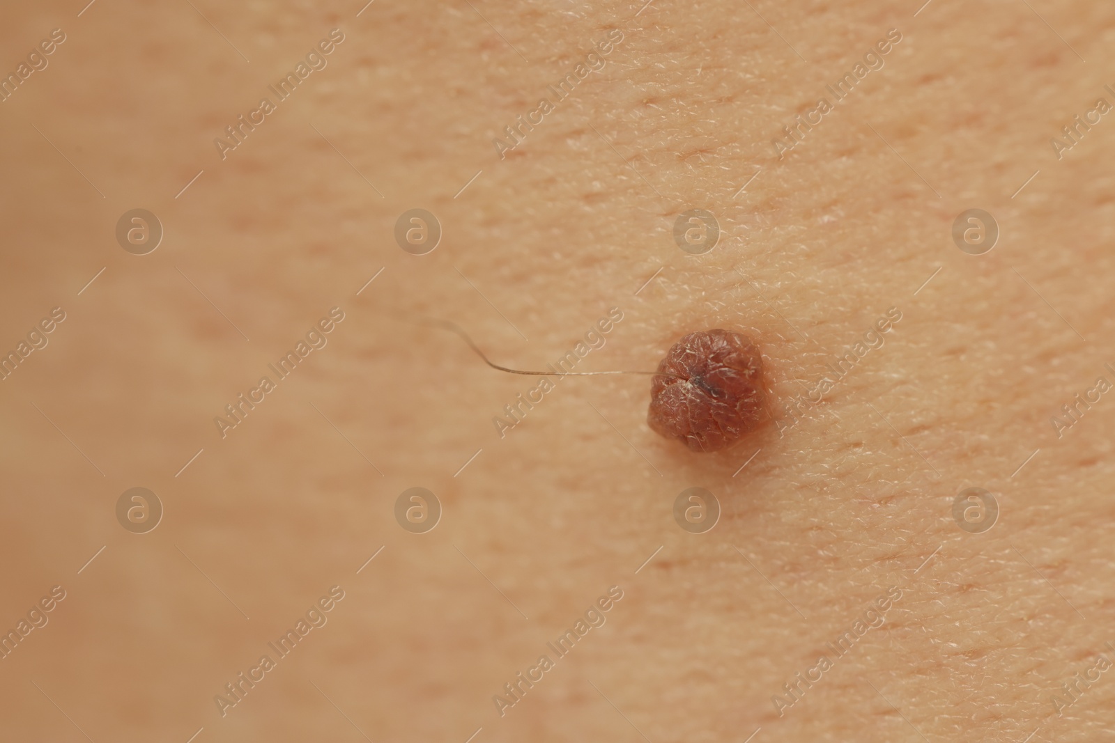 Man with mole on his skin, closeup. Space for text Photo of Man with mole on his skin, closeup. Space for text