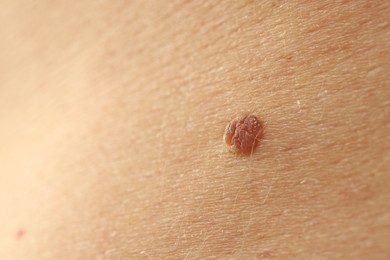 Photo of Man with mole on his skin, closeup. Space for text