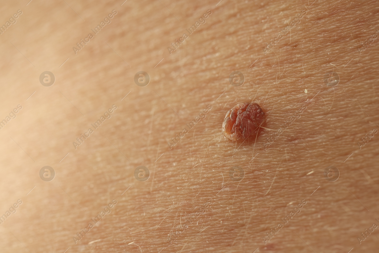 Man with mole on his skin, closeup. Space for text Photo of Man with mole on his skin, closeup. Space for text