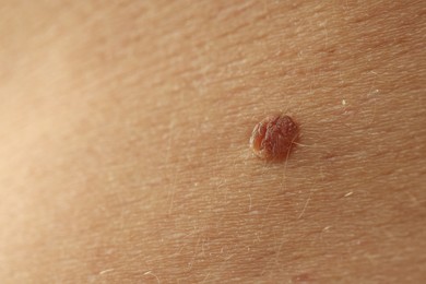 Photo of Man with mole on his skin, closeup. Space for text