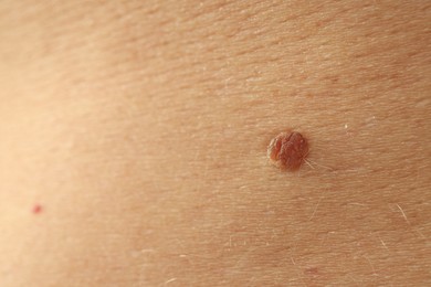 Photo of Man with mole on his skin, closeup. Space for text