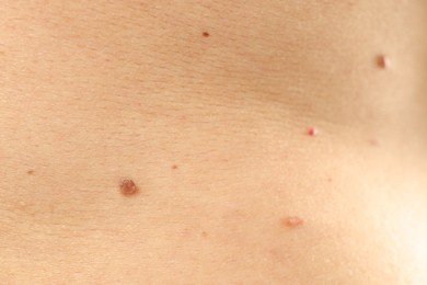 Photo of Man with moles on his skin, closeup
