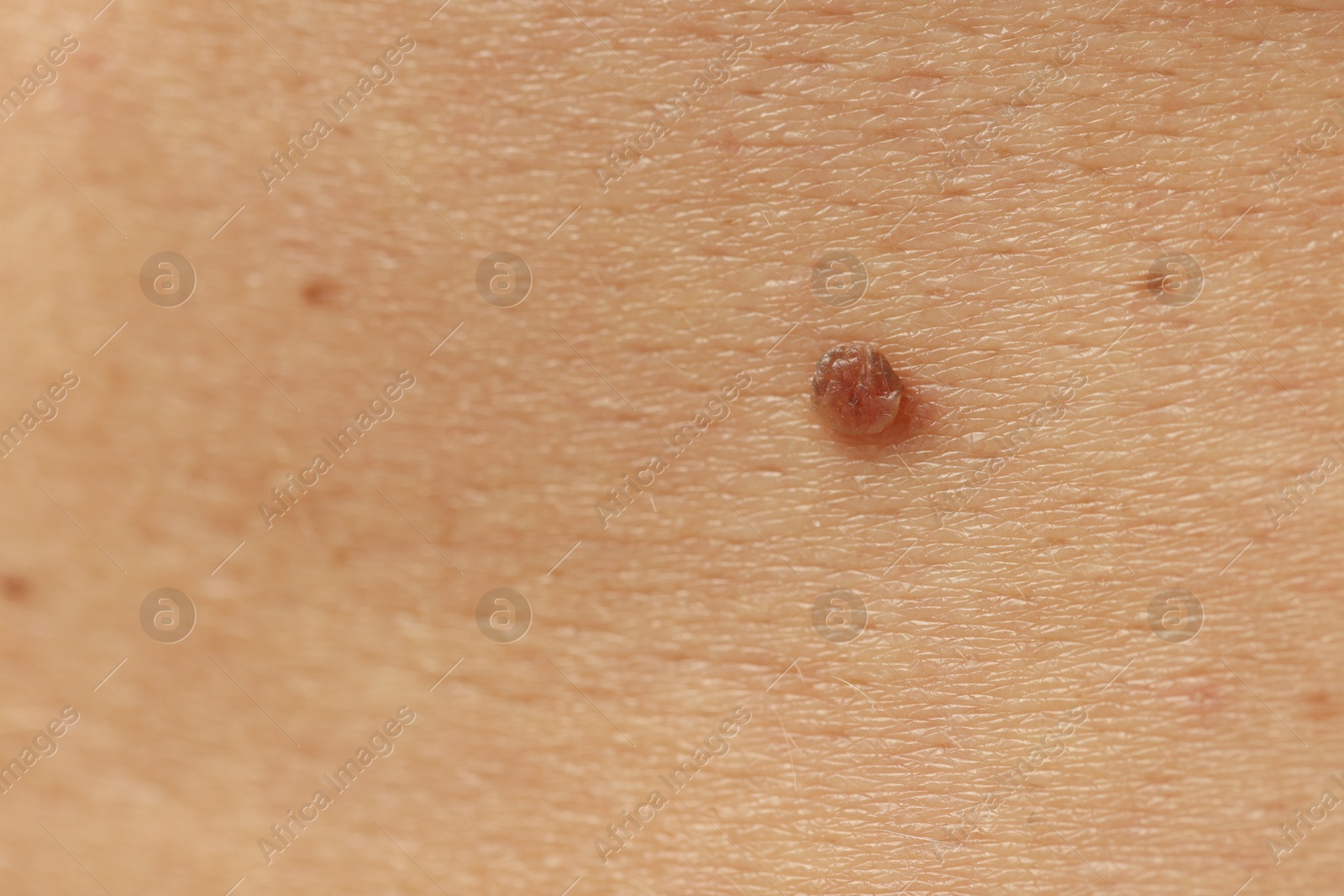 Man with mole on his skin, closeup Photo of Man with mole on his skin, closeup