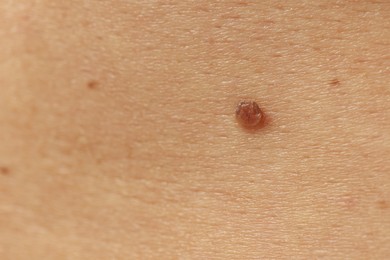 Photo of Man with mole on his skin, closeup