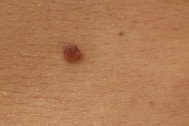 Photo of Man with mole on his skin, closeup