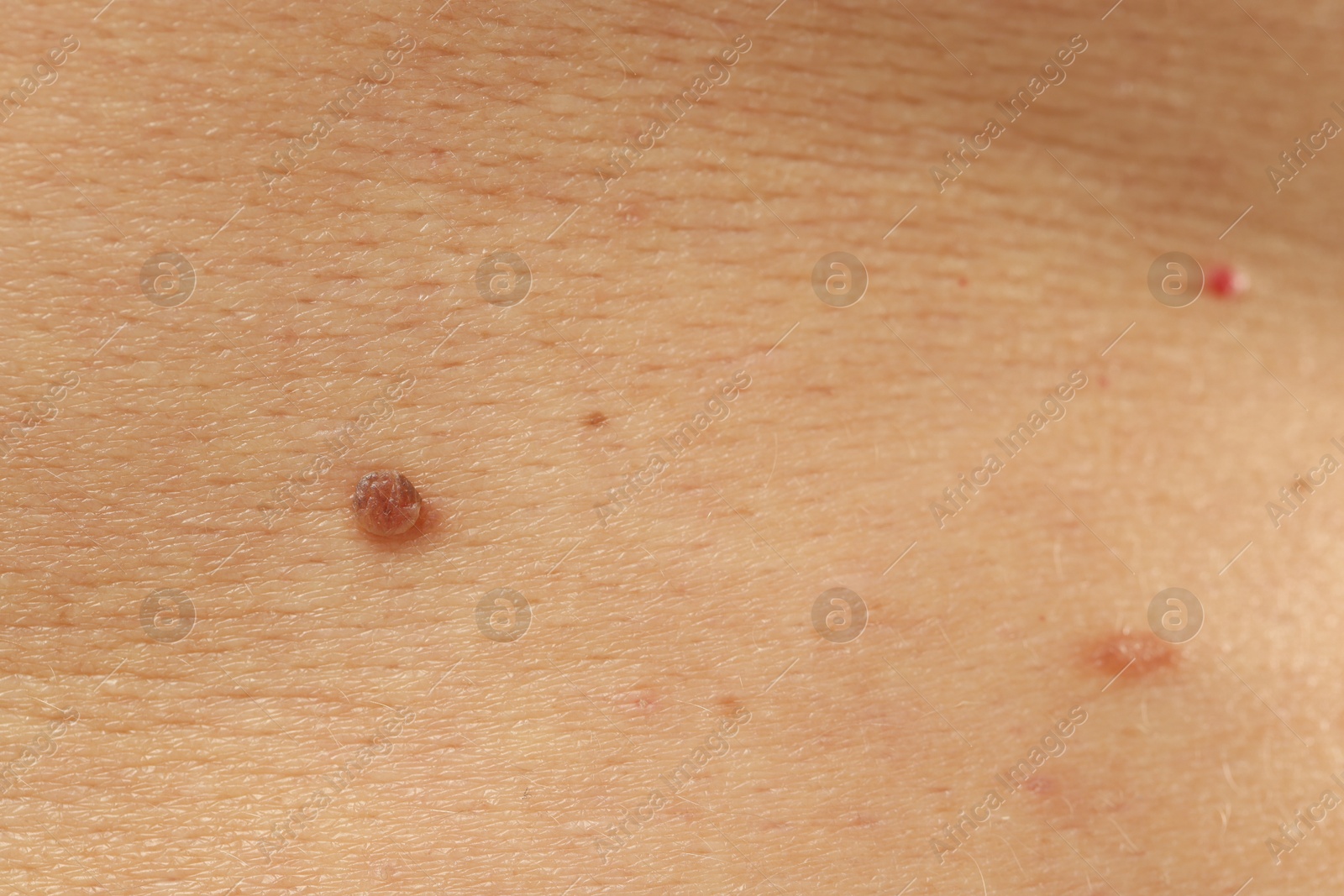 Man with moles on his skin, closeup Photo of Man with moles on his skin, closeup