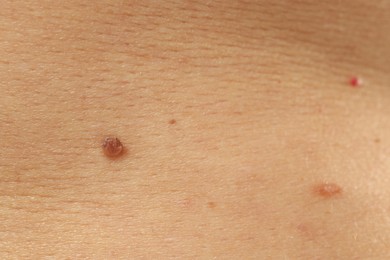 Photo of Man with moles on his skin, closeup