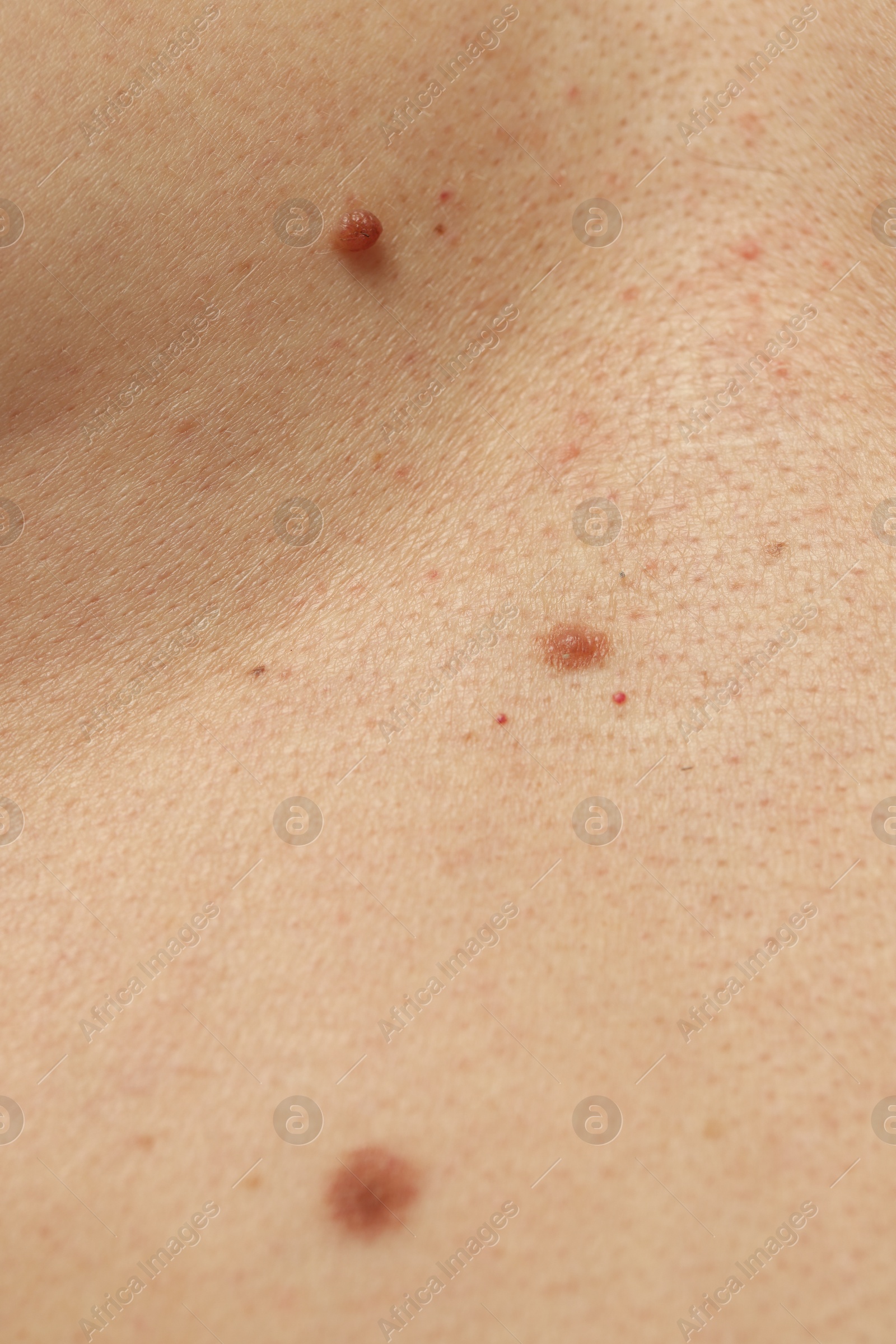 Man with moles on his skin, closeup Photo of Man with moles on his skin, closeup