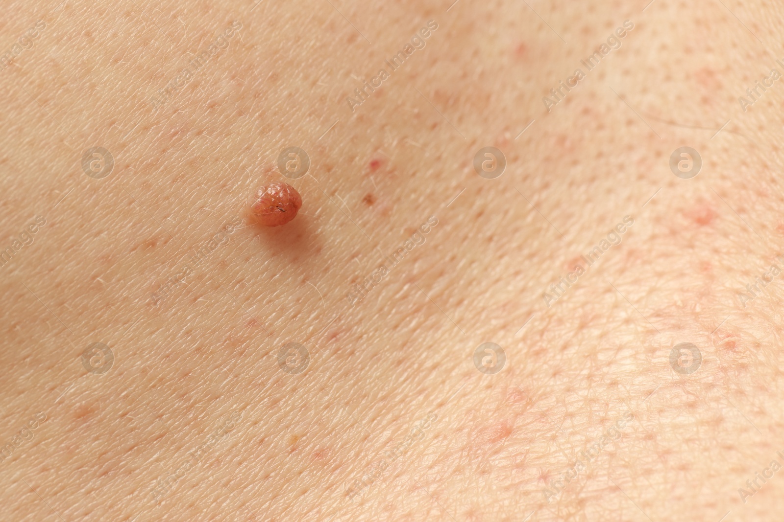 Man with mole on his skin, closeup Photo of Man with mole on his skin, closeup